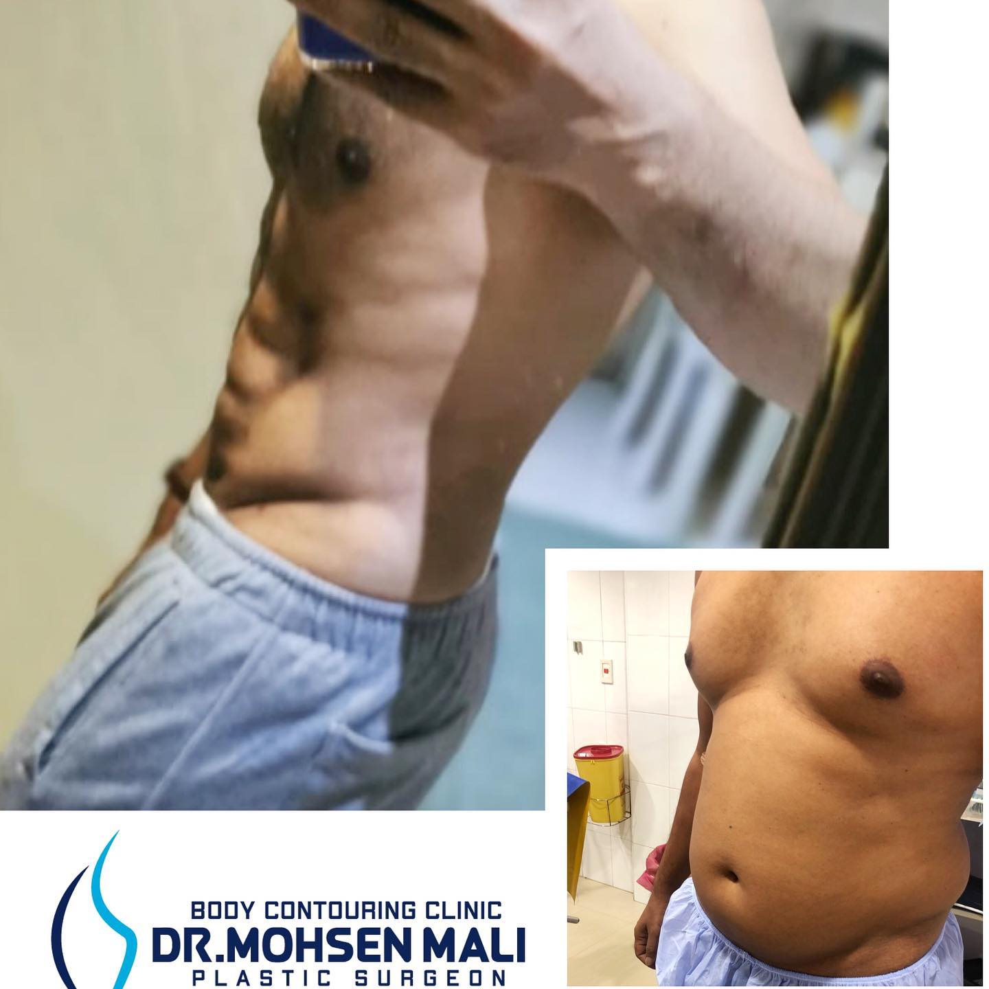 علاج حالات التثدى عند الرجال باستخدام شفط الدهون او علاج التثدى 